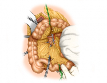 Dividing the right colic artery