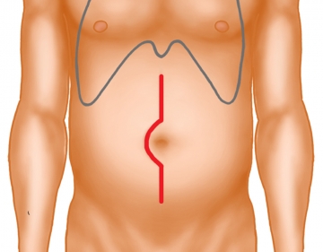 Laparotomy