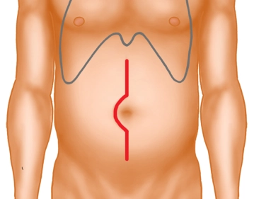 Laparotomy