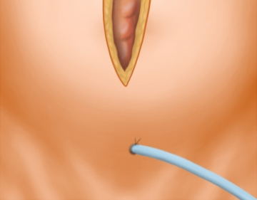 Bladder catheter / Setting up the surgical field