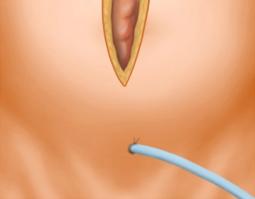 Bladder catheter / Setting up the surgical field