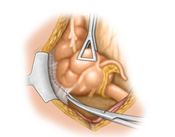 Mobilizing the ascending colon