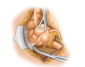 Mobilization of the ascending colon