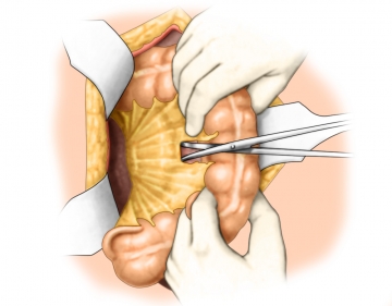 Mobilizing the mesenteric root