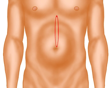 Excision of the skin scar