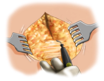 Exposure of the fascial defect