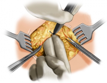 Opening the abdominal cavity