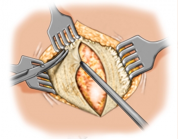 Dissecting the anterior fascia