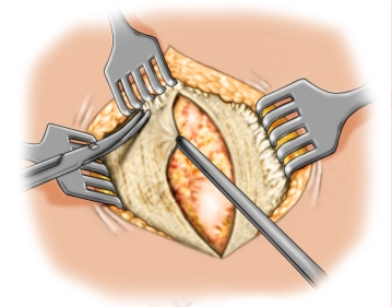 Preparation of the anterior fascia