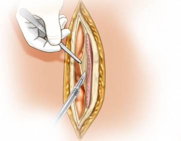 Incising the rectus sheath