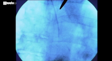 Inserting the port tubing