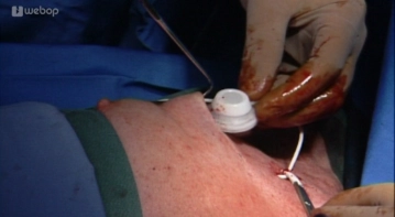 Preparing the port pouch