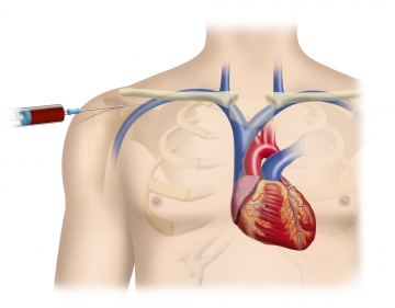 Puncturing the subclavian vein