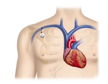 Subcutaneous tunneling
