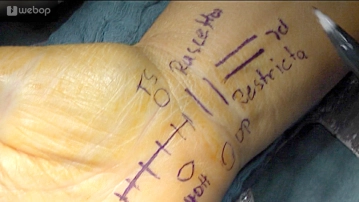 Planning/Skin Incision 2