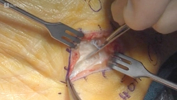 Transection of Palmar Aponeurosis 2
