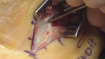 Transection flexor retinaculum