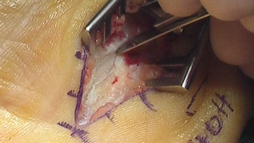 Transection of the Flexor Retinaculum 2