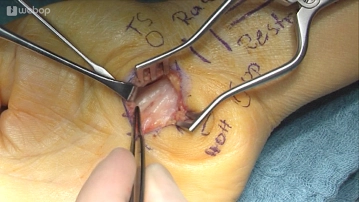 Exposure and Inspection of Median Nerve and Flexor Tendons 2