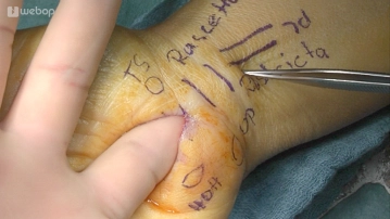 Digital Carpal Tunnel Test