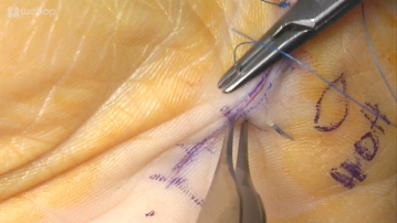 Irrigation and skin suture 2