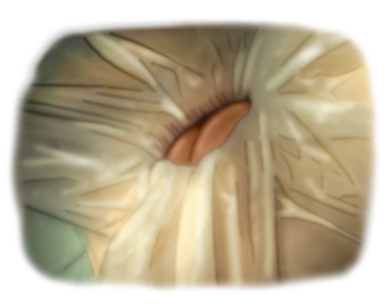 Luxación del intestino; Evaluación de hallazgos