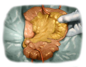 Determinación de los límites de resección