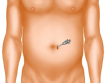 Incisión cutánea paraumbilical