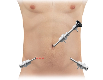 Movilización de la flexura cólica derecha