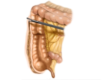 Inicio de la movilización del hemicolon derecho
