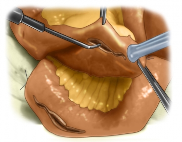 Incising the ends of the intestine