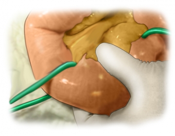Determining the resection margins