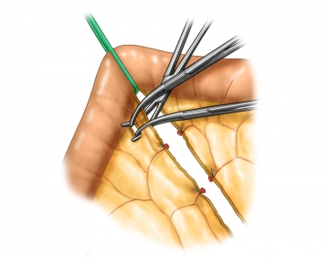 Dividing the mesentery