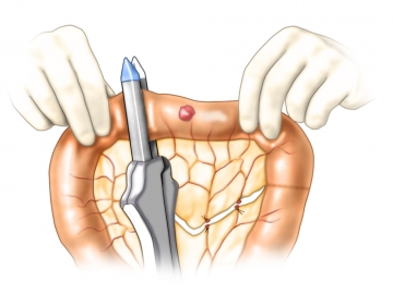 Preparing the side-to-side anastomosis