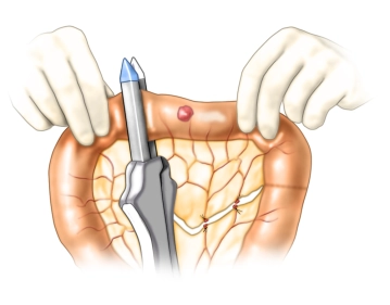 Preparing the side-to-side anastomosis