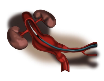 Realización de una angiografía de visión general