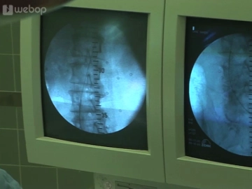 Colocación del alambre guía rígido (desde la izquierda)