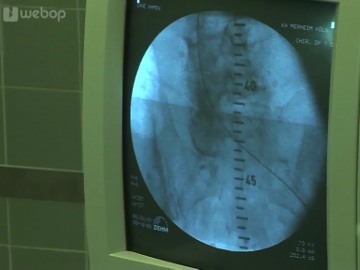 Platzierung eines Angiographiekatheters (von rechts)