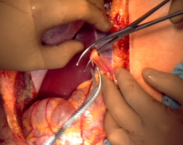 Movilización del hígado