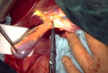 Colecistectomía y preparación del lig. hepatoduodenal