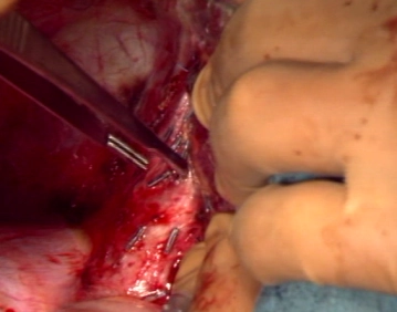 Movilización del lóbulo hepático derecho