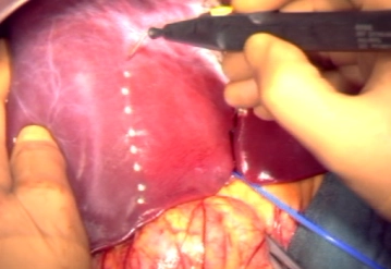 Determinación y marcaje de la línea de resección