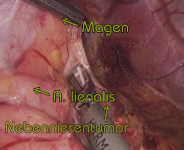 Accessing the adrenal