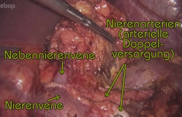Mobilizing the adrenal tumor