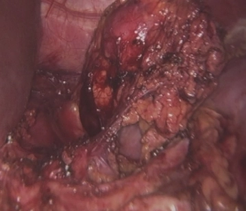 Removing the entire adrenal