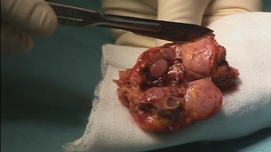 Retrieving the specimen and placing a drain