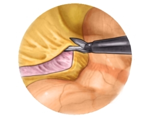 Freeing the descending colon