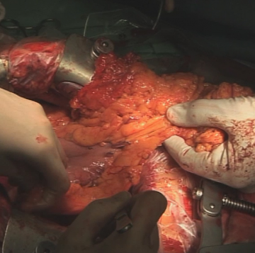 Dividing the greater omentum