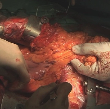 Dividing the greater omentum