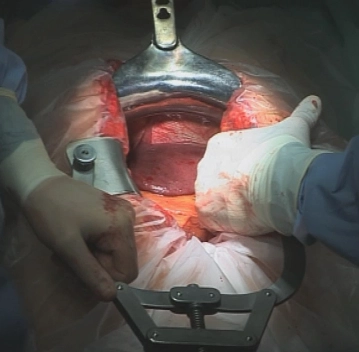 Laparotomy and exploration